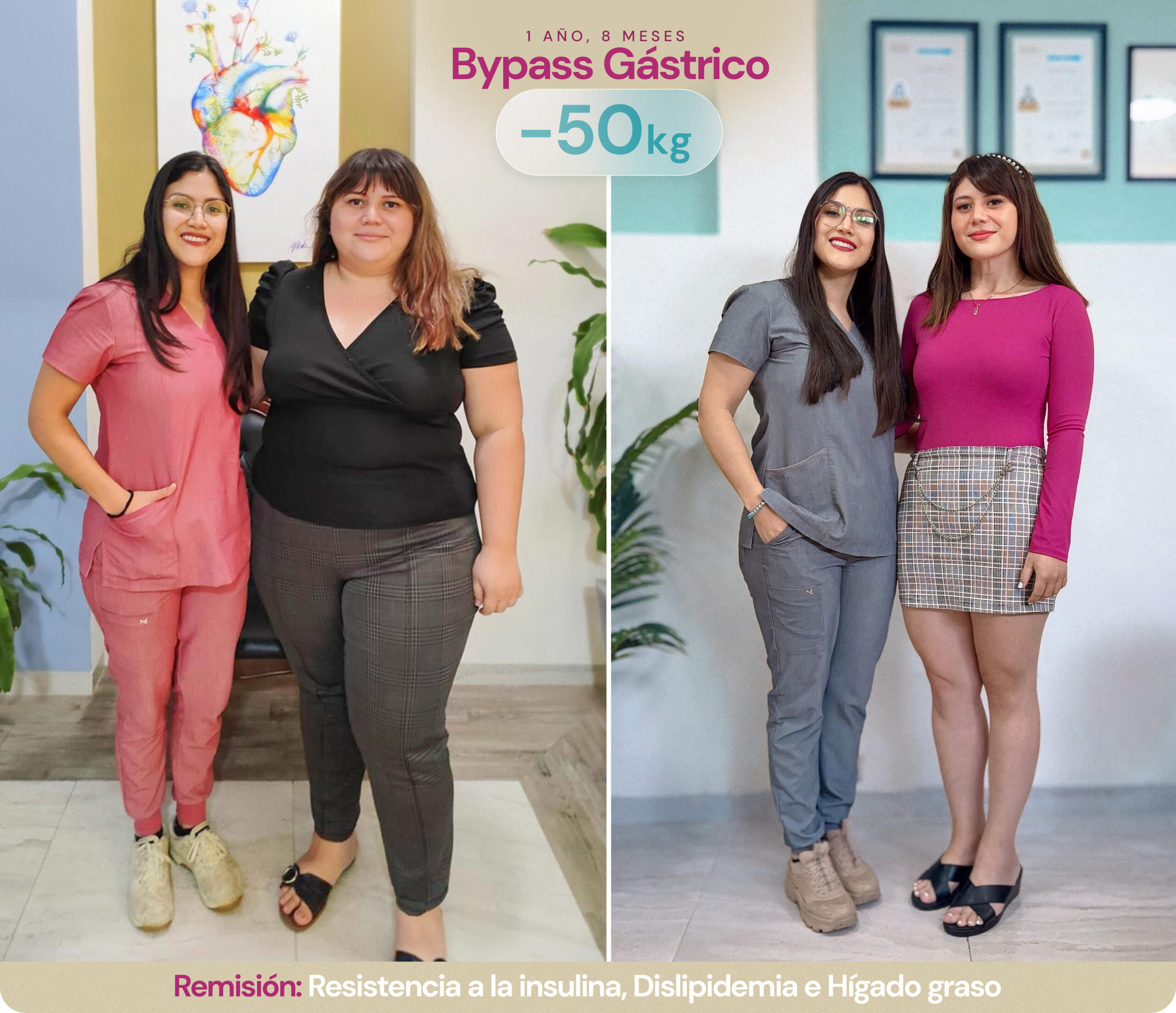 Bypass Gástrico 1 Año